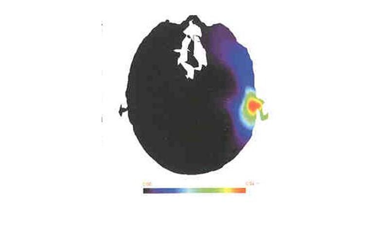 Abbildung 2: Profil des Temperaturanstiegs bei Belastung durch ein Mobiltelefon mit 1 W Leistung bei 1,8 GHz; Bild: Dr. Franz-Joachim Kauffels (Archiv: Vogel Business Media)