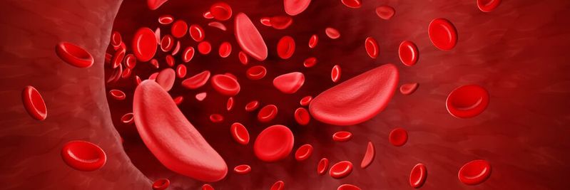 Die sonst sehr flexiblen roten Blutkörperchen werden bei Menschen mit Sichelzellkrankheit steif und nehmen bizarre Formen an, die an eine Sichel erinnern, was der Erkrankung ihren Namen verlieh.(Bild:  Artur - stock.adobe.com)