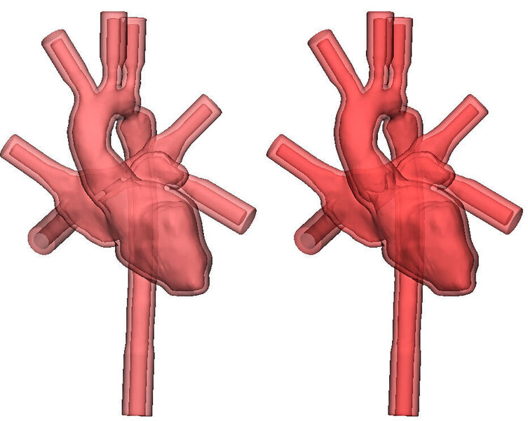 Zur Optimierung der Herzmodelle wurden mit Hilfe von 3-matic Herzklappen eingefügt. (LMU Klinikum)