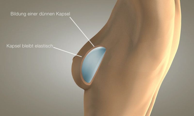 In einer Studie konnte jetzt die Effizienz der Beschichtung „BioShield-S1“ nachgewiesen werden: Die Kapseln um die seidenbeschichteten Implantate waren dünner, flexibler und durchsichtiger, kombiniert mit einer deutlichen Reduzierung der Entzündungsmarker (Bild: Amsilk)