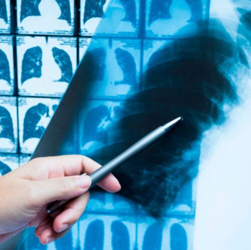 Because CT scans capture areas of the body beyond the lungs, doctors often see abnormalities that might indicate cancer in other parts of the body, including the kidneys, liver and lymph nodes.(Source:  Brown University)