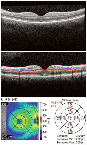 Makulascan mit aufeinanderfolgender Einzelschichtanalyse des rechten Auges (R). Oben: Roh-B-Scan der Makula. Mitte: Segmentierung bestimmter Netzhautschichten mit der Software Heidelberg Eye Explorer. Unten links: Kartierung der Schichtdicke; unten rechts: Messungen des durchschnittlichen Volumens und der Dicke der jeweiligen Netzhautschichten in Bezug auf das ETDRS-Gitter (Early Treatment Diabetic Retinopathy Study). Das ETDRS-Gitter wird von der OCT-Software als Muster zur Berechnung der Dicken- und Volumenmessungen für jeden Quadranten verwendet. (Uniklinik Ulm)