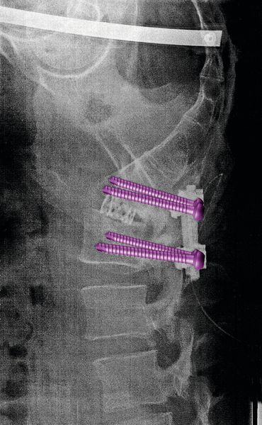 Titanimplantate: Denis During trägt Implantate aus Titan im Rücken. Damit bei diesen Operationen auch die richtigen Elemente zum Einsatz kommen, sind sie eingefärbt. (Bild: During)