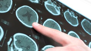 Die Hirnforschung beschäftigt eine besondere Form von Epilepsie, die immunvermittelt ist. Ein FWF-Projekt konnte jetzt zwei dafür verantwortliche Schadensprozesse identifizieren. (Quelle: Shutterstock/ sfam_photo)