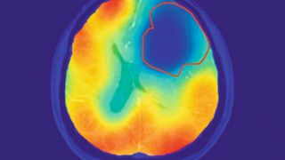 Die rote Linie markiert das Tumorareal; der farbige Kontrast zeigt den Sauerstoff-Stoffwechsel an. Wie vom Warburg-Theorem vorhergesagt, ist der Sauerstoff-Umsatz im Tumor reduziert (blau). (Bild: © Paech / Radiology)