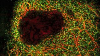 Eine mit dem RSOM-System erstellte optoakustische Aufnahme eines Melanoms (dunkler Bereich) in Hautgewebe mit der ihn umgebenden Struktur feinster Blutgefäße. (Bild: Aus: “Multispectral Optoacoustic Dermoscopy: Methods and Applications”, M. Schwarz, 2017, mediatum.ub.tum.de)