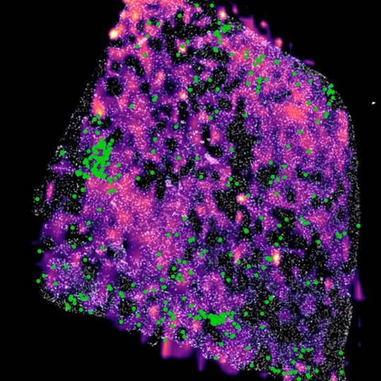 An IDH-mutant human glioma tumor, showing clusters of CD8+ T cells in green, and a gradient of purple to pink representing low to high D-2HG concentrations. CD8+ T cells were more abundant in areas with less D-2HG, and less abundant in regions with more D-2HG, suggesting that D-2HG has an effect on the immune cells. An IDH-mutant human glioma tumor, showing clusters of CD8+ T cells in green, and a gradient of purple to pink representing low to high D-2HG concentrations. CD8+ T cells were more abundant in areas with less D-2HG, and less abundant in regions with more D-2HG, suggesting that D-2HG has an effect on the immune cells.