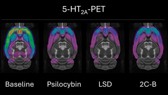 5-HT2A-PET(Source:  Mikael Palner/ University of Southern Denmark)