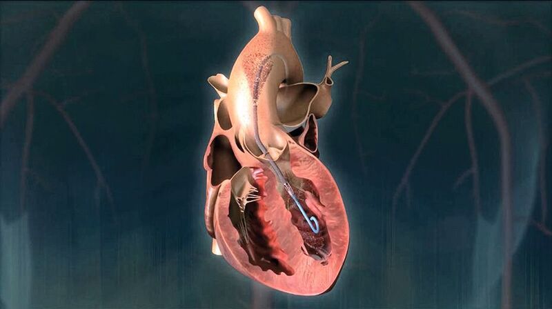 Impella-Herzpumpen sind perkutane Herzunterstützungssysteme (pVAD), die kurzfristig mechanisch das Herz entlasten.  (Abiomed)