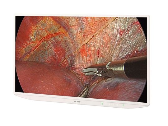 Der LMD-XH550MD ist so konstruiert, dass auch in hell ausgeleuchteten OP-Sälen Blendeffekte minimiert werden, damit OP-Teams ein klares Bild mit hohen Kontrasten erhalten.(Bild:  Sony)