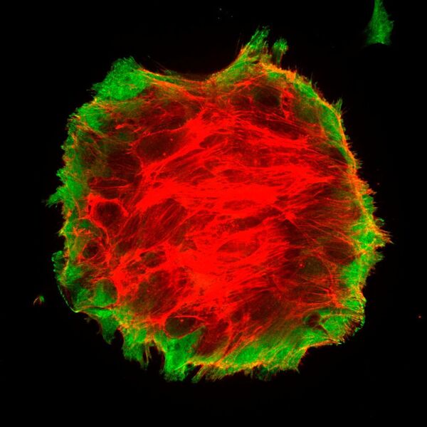 Breast cancer cells beginning to detach from a surface to form a spherical aggregate. In red, the actin cytoskeleton stretching the adhesions to the substrate (paxilina, in green).  (IBEC)