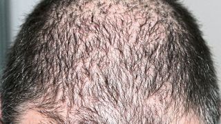 Mit Haarausfall haben viele Menschen zu kämpfen. Eine seltene Form des Haarausfalls ist Hypotrichosis simplex, die bereits im Kindesalter eintritt (Symbolbild). (Pixabay/kalhh)