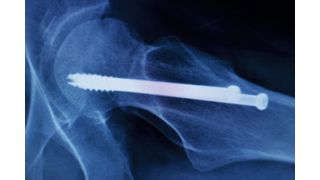 Medizinische Implantate stabilisieren beispielsweise verletzte Knochen und ermöglichen so deren Heilung.  (©edwardolive - stock.adobe.com)