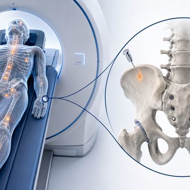 Die PET erfasst das Knochenmark über einen großen Teil des Körpers und kann räumlich verteilte Herde sichtbar machen. Die Knochenmarkprobe untersucht dagegen nur kleine Bereiche an den Beckenkämmen. Die Studie prüfte, ob bei einer unauffälligen Ganzkörper-PET unter festgelegten Voraussetzungen auf die invasive Entnahme verzichtet werden kann. (Bild: Guido Deußing / KI-generiert)
