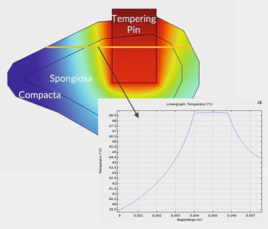 Beispiel für eine simulationsgestützte CAPA-Analyse aus dem Kontext „thermisches Risiko". Die Temperaturverteilung im umgebenden Knochen beim Einsatz eines beheizten Pins ist messtechnisch schwer zugänglich, simulativ aber sauber bestimmbar – inklusive Temperaturverlauf entlang einer kritischen Bewertungslinie. (Bild:  bolts&bytes engineering)