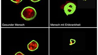 Blutplättchen von gesunden Menschen (oben) und Mäusen (unten) besitzen ein dichtes Zellskelett (rot), das von einem Ring aus sogenannten Mikrotubuli (grün) umsäumt ist. Bei Wiskott-Aldrich-Patienten und bei Mäusen mit einem Gendefekt an Profilin1 ist das Zellskelett kaum ausgeprägt; der Mikrotubuli-Ring ist verdickt und verdrillt. (Bild: Simon Stritt)