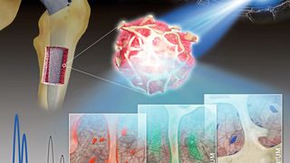 Räumlich hochaufgelöste Synchrotron-Röntgenfluoreszenzanalysen von humanen Knochen- und Knochenmark-Biopsien zeigen die spezifischen Verteilungsmuster von Metallen (Kobalt, Chrom und Titan), die aus Legierungen von Endoprothesen freigesetzt werden. (Bild: Naujok/ Charité)