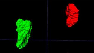Left and right adrenal automated 3D segmentation in chest CT. (Source: Elena Ghotbi, M.D., and RSNA)