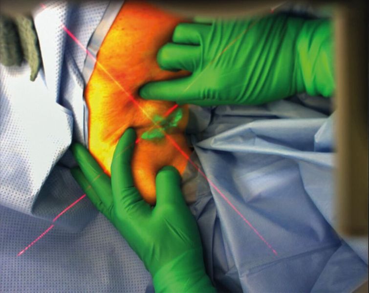 Forscher des Fraunhofer-Instituts für graphische Datenverarbeitung IGD haben eine Datenbrille für Operationen entwickelt. Diese soll in Kombination mit dem Fluoreszenzfarbstoffs Indocyaningrün (ICG) und einem Stereo-System aus Nahinfrarotkameras (NIR) für die intraoperative Visualisierung und Entfernung von Schildwächterlymphknoten eingesetzt werden. 3D ARILE ist ein ZIM (Zentrales Innovationsprogramm Mittelstand) gefördertes Forschungsprojekt. (Bild: Fraunhofer IDG)