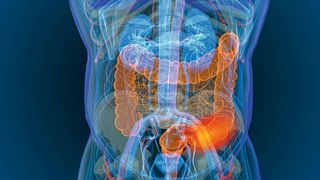 Übergewicht ist ein Risikofaktor für Darmkrebs. Dies haben Forscher nun auch für frühe Erkrankungenbei unter 55-Jährigen gezeigt (Symbolbild). (©appledesign - stock.adobe.com)