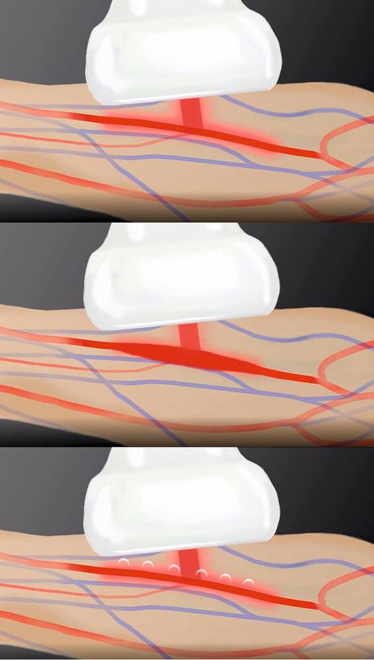Abb. 1: Bei der optoakustischen Bildgebung wird das Gewebe mittels eines Laserstrahls kurzer Dauer angeregt (oben), die Absorption des Laserlichts führt zur Ausdehnung des Gewebes (Mitte) und dadurch bedingter Aussendung von Ultraschallpulsen (unten), welche ein Detektor aufnimmt und in Bildinformation umsetzt.(Bild:  iThera Medical)