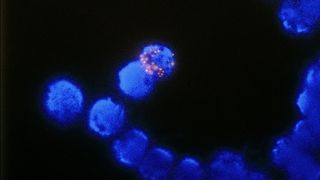 1		Fluoreszenz-in-situ-Hybridisierung (Fish) zur Bestimmung der Genamplifizierung des HER-2-Proteins, eines Indikators für Brustkrebs.  (Bild: Dr. Kübler GmbH)