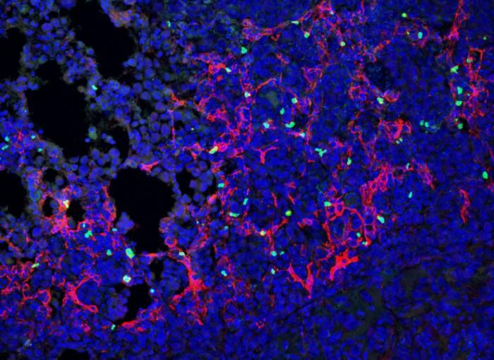 So entgeht Lungenkrebs dem Immunsystem  Forscher der Columbia University haben eine neue Zellart entdeckt, die Lungenkrebse vor Angriffen des Immunsystems schützt.  Die neuen Zellen wurden während eines größeren Projekts entdeckt, das die Rolle von Fibroblasten untersuchen sollte – scheinbar normale Zellen, die häufig rund um solide Tumore vorkommen. Die Analyse mittels Single-Cell Transcriptomic Profiling offenbarte zuvor unbekannte Fibroblasten, die ein Gen namens CHL1 exprimierten – dieses Gen kommt normalerweise nicht auf Fibroblasten in gesunden Lungen vor.  Das Team lernte schließlich, dass die neu identifizierten Fibroblasten Lungenkrebs fördern, indem sie regulatorische T-Zellen an die Tumorgrenze rekrutieren. Normalerweise schützen regulatorische T-Zellen die Lunge, indem sie Überreaktionen des Immunsystems verhindern. Im Kontext von Lungenkrebs schützt diese Immunsuppression jedoch vor allem den Tumor.  Das Bild zeigt Fibroblasten (pink), die regulatorische T-Zellen (grün) zu Lungentumoren rekrutieren und so verhindern, dass das Immunsystem die Tumore angreift.  Hier geht‘s zur Originalmeldung Wissenschaftsbild des Tages vom 3.9.2026 (Bild: Olivia Ringham, Columbia University Vagelos College of Physicians and Surgeons.)