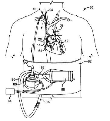 Doppellumen-Drainagekanüle mit internem Durchflussbegrenzer(Bild:  CardiacAssist/DPMA)
