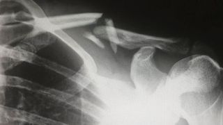 „Nach der Operation, bei der die Bruchstücke mit einer Schiene verschraubt werden, wissen wir heute lange Zeit nur wenig über den Verlauf der Heilung“, erklärt der Unfallchirurg Professor Tim Pohlemann. (gemeinfrei)