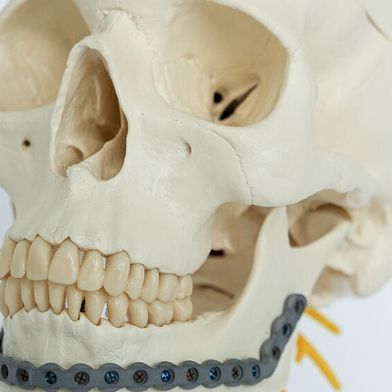 Osteosynthese-Implantat für einen Unterkiefer, ausgerüstet mit einer mittels Micro-Arc-Oxidation hergestellten porösen Oberfläche. (Bild: Fraunhofer IFAM)