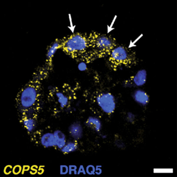 Abb. 4: Fluoreszenz-in-situ-Hybridisierung (FISH): Zellkerne werden mit dem blauen Farbstoff DRAQ5 sichtbar gemacht. mRNA von COPS5 wird mit einem gelb fluoreszierenden Farbstoff versehen. Die Pfeile markieren Zellen, in denen COPS5 hochreguliert ist. Der weiße Maßstabsbalken kennzeichnet die Länge 10µm. (Bild: entnommen aus Bajikar et al., PNAS 111, E626-E635 (2014) [1])