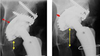 Migration einer konventionellen Pfannenkomponente: postoperativ (li.) und 3 Jahre postoperativ (re.). Die Migration der Hüftprothesenpfanne kann zum Teil erheblich sein, so dass eine Revision erfolgen muss. (Bild: IFUM)