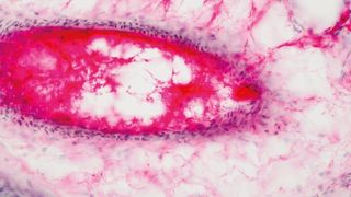 Abb. 1: Krebsdiagnostik: Ob Gewebe bösartig entartet ist, wird häufig anhand einer dem Körper entnommenen Gewebeprobe beurteilt. Im Bild: mikroskopische Darstellung von menschlichem Lungengewebe. (©tonaquatic - stock.adobe.com)