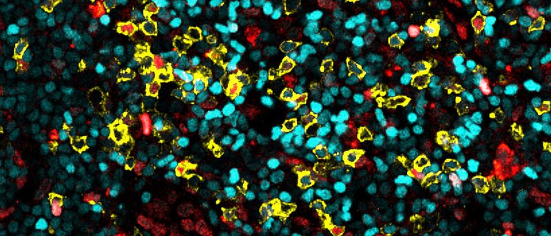 Immunwächter im Lymphknoten  Anders als bislang bekannt, verbleiben bestimmte T-Zellen über längere Zeit in Lymphknoten und speichern dort Informationen zu Immunreaktionen. Das haben Forschende der Uni Würzburg und der Uniklinik Aachen herausgefunden.  „Bis dato ging man davon aus, dass Tregs (regulatorische T-Zellen) zwischen Lymphknoten im gesamten Körper zirkulieren, um Immunreaktionen zu koordinieren“, sagt Dr. Milas Ugur, Leiter der Studie am Institut für Systemimmunologie an der Julius-Maximilians-Universität. „Wir konnten jedoch zeigen, dass es auch residente Tregs gibt, die über längere Zeit in bestimmten Lymphknoten verbleiben. Einige nisten sich dort sogar über mehrere Monate ein.“ Noch zu klären ist die Frage, ob sich diese neu entdeckte Eigenschaft der Zellen auch therapeutisch nutzen lässt – zum Beispiel bei Allergien. Das Bild oben zeigt Immunzellen in einem Lymphknoten. Ansässige Zellen sind rot, zirkulierende in cyan markiert. Auffällig ist: Regulatorische T-Zellen (gelb umrandet) sind in beiden Formen zu finden.   Hier gehts zur Originalmeldung Wissenschaftsbild des Tages vom 16.11.2023 (Milas Ugur/JMU)