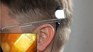 Ein ultradünnes Kabel wird vom Chip im Auge entlang der Kopfseite hinter das Ohr des Patienten verlegt. Dort befindet sich der Anschluss für das Steuergerät. (Bild: Retina Implant)