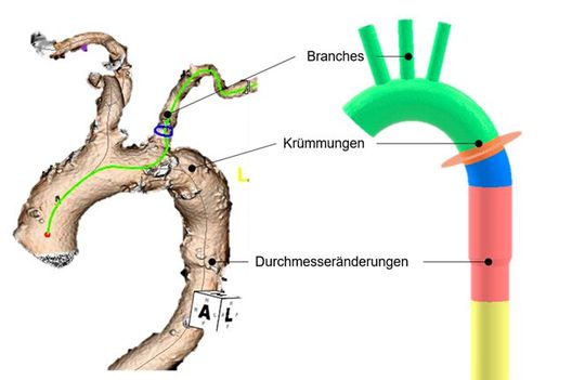 Im Rahmen des Forschungsprojekts wurden drei Individualisierungselemente (Durchmesseränderung, Branch und Krümmung) für einen patientenindividualisierten Stentgraft erarbeitet. Im Rahmen des Forschungsprojekts wurden drei Individualisierungselemente (Durchmesseränderung, Branch und Krümmung) für einen patientenindividualisierten Stentgraft erarbeitet.