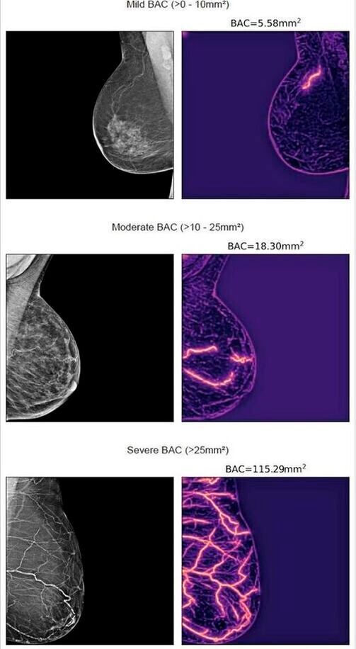 The study shows that AI can be used to assess the build-up of calcium deposits in the arteries of the breast from the standard X-ray mammography scans that are currently used in routine breast cancer screening.(Source:  ESC)