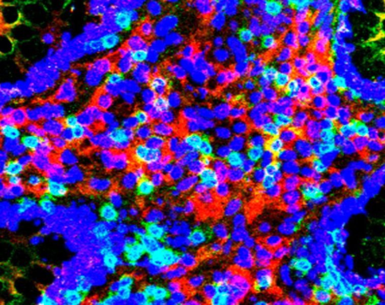 Auf dem Bild ist eine Biopsie von Darmgewebe (Dickdarm) eines Morbus Crohn-Patienten dargestellt. Blau sind Zellkerne angefärbt, grün T-Zellen und rot das CYLD-Molekül, gelb eine Kolokalisation von CYLD und T-Zellen. Das Bild zeigt deutlich eine erhöhte Infiltration von entzündungsfördernden T-Zellen in das Darmgewebe von Morbus Crohn-Patienten. Interessant ist hierbei, dass diese Zellen auch das CYLD Molekül verstärkt exprimieren. (Katharina Gerlach und Benno Weigmann)
