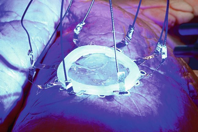 Eine neue Technik, die von Forschern der Universität von Minnesota entwickelt wurde, ermöglicht den 3D-Druck von Hydrogel-basierten Sensoren direkt auf Organe, die wie die Lunge ihre Form verändern oder sich durch Ausdehnen und Zusammenziehen verformen.

Dies könnte moderne medizinische Behandlungen auf unzählige Arten unterstützen, wie das Drucken von Elektrodenarrays für neuronale Schnittstellen und das Drucken von biologischen Gerüsten (Scaffolds) mit manipulierten Zellen zur Geweberegenerierung. 

Mehr zum Thema: https://www.mission-additive.de/forscher-drucken-sensoren-direkt-auf-organe-a-944075/ (McAlpine-Forschungsgruppe, Universität von Minnesota)