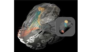 Affected brain circuits in Parkinson’s disease (green), dystonia (yellow), Tourette’s syndrome (blue), and obsessive-compulsive disorder (red). Inset: the optimal target areas for deep brain stimulation in the basal ganglia.  (Source: Charité/ Barbara Hollunder)