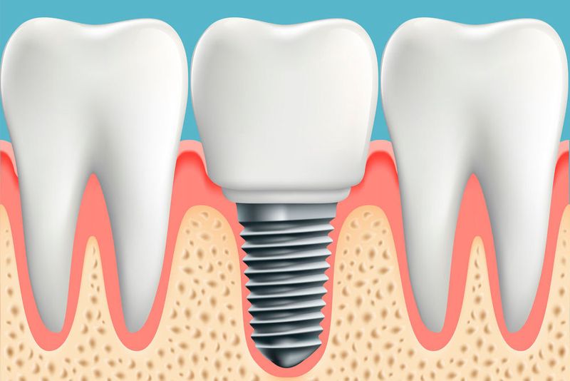 Schemadarstellung eines Implantats im Kiefer. (Trifonenko Ivan/Fotolia)