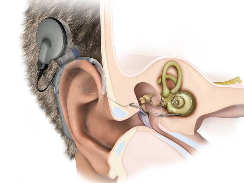 Die wesentlichen Elemente eines Cochlea-Implantats sind der außen getragene Sprachprozessor, die im Knochen implantierte Empfängereinheit und die Elektrode, die den Hörnerv anregt. (Bild: MED-EL Elektromedizinische Geräte)