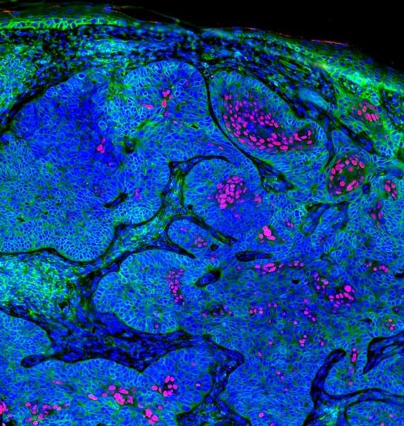 Tumor-/ Immunsystem Versteckspiel  Basalzellkarzinome (BCCs) sind weit verbreitete Hautkrebsarten. Trotz ihrer hohen Mutationsrate besitzen sie eine überraschend niedrige Immunogenität – d.h. die Fähigkeit, eine Immunantwort im Körper hervorzurufen. Eine Studie des Massachusetts General Hospital unter der Leitung von Dr. Shawn Demehri legt nun nahe, dass ein Unterdrückung der Antigenpräsentation hierfür verantwortlich ist.  Initiiert wird die Unterdrückung durch die Ursprungszellen des Tumors. BCCs zeigen niedrige Expression menschlicher Leukozytenantigene (HLA Klasse I), was die Erkennung durch spezielle Immunzellen (CD8+ T-Zelle) erschwert. Im Vergleich zu Plattenepithelkarzinomen (SCCs) weisen BCCs weniger T-Zellen innerhalb des Tumorgewebes auf, was zu ihrer geringen Immunogenität beiträgt. Ein Protein (Foxc1) unterdrückt dabei in BCC-Zellen die Leukozytenantigene-Expression über epigenetische Wege, ähnlich wie in ruhenden Haarfollikel-Stammzellen.  Doch es gibt Hoffnung: Die Wissenschaftler konnten zeigen, dass die Behandlung mit einer speziellen Wirkstoffkombination in präklinischen Studien vielversprechende Ergebnisse in der BCC-Bekämpfung zeigt. Diese Kombination könnte die Wirksamkeit der BCC-Behandlung erheblich verbessern, bedarf aber weiterer klinischer Forschung.   Auf dem Bild zu sehen sind Tumorzellen, die das Protein Foxc1 (rot) exprimieren, welches die HLA-Klasse-I (grün) in den Tumorzellen unterdrückt. Hier gehts zur Originalmeldung Wissenschaftsbild des Tages vom 24.4.2025  (Bild: Shawn Demehri, Massachusetts General Hospital)