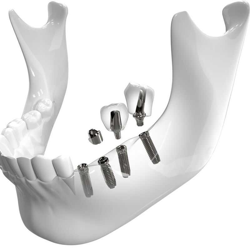 Die Herstellungvon Zahnimplantaten auf CNC-Mehrspindelautomaten stellt eine wirtschaftliche Alternative zu herkömmlichen Verfahren dar. 