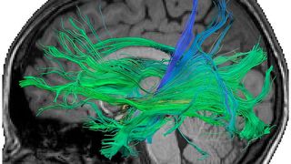 Faserverbindungen im Gehirn, die durch den Hippocampus verlaufen und mit dem Abruf von numerischen Fakten assoziiert sind. Medienbasierte Trainings erhöhten die Stärke und Leitfähigkeit von Fasern, die mit dem Langzeitgedächtnis verbunden sind. (Leibniz-Institut für Wissensmedien (IWM))