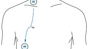 Anordnung der Elektroden zur Erfassung des IKG-Signals. (Bild: Analog Devices)