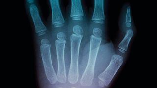 Das nach dem deutschen Physiker Wilhelm Conrad Röntgen benannte bildgebende Verfahren findet seit über 120 Jahren regelmäßige Anwendung in aller Welt. (© SLX)