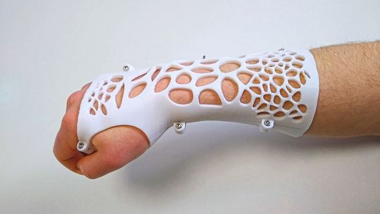 3D-gedruckte Armschiene: Das 3D-Modell passt sich dem 3D-Scan des Arms an. Es ist möglich, beschädigte Bereiche auszuwählen, um Material in diesem bestimmten Bereich zu vermeiden.(Bild:  Replique)