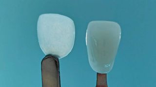 Links die Ultrathineer Verblendung aus Zirkoniumdioxid – rechts eine herkömmliche Verblendung (Bild: BMF)