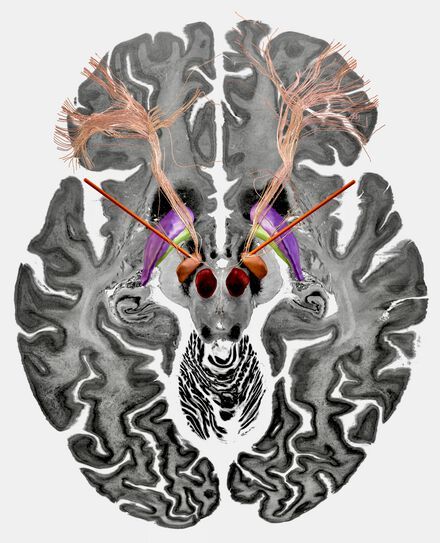 The therapeutic fibre bundle for the treatment of obsessive-compulsive disorder. Electrodes placed in the subthalamic nucleus.(Source:  Charité/ Barbara Hollunder)